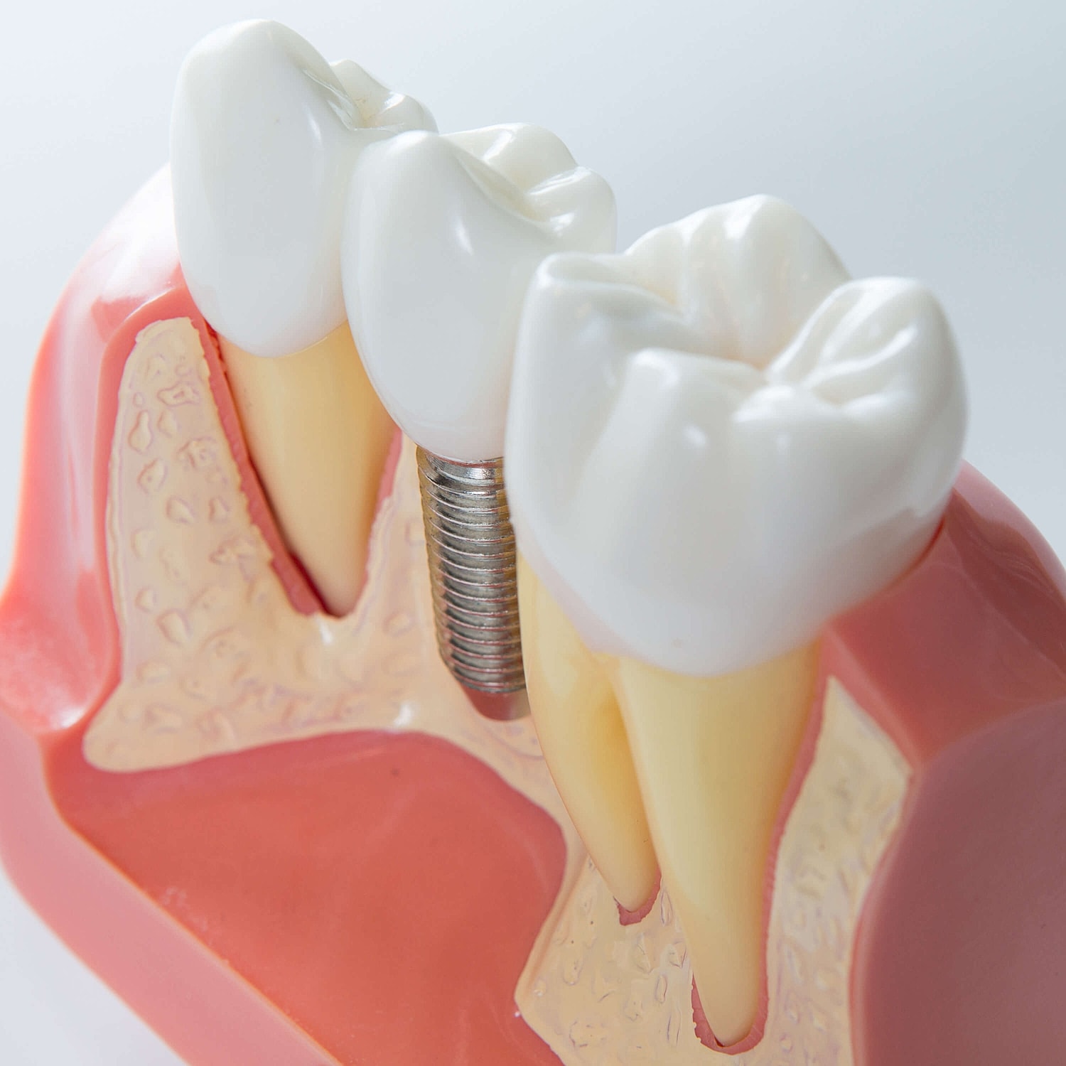 Dental implant model showcasing tooth replacement.