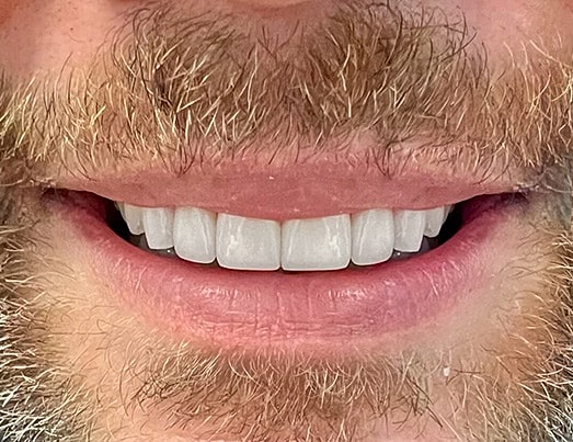 Smile Makeover  Before & After