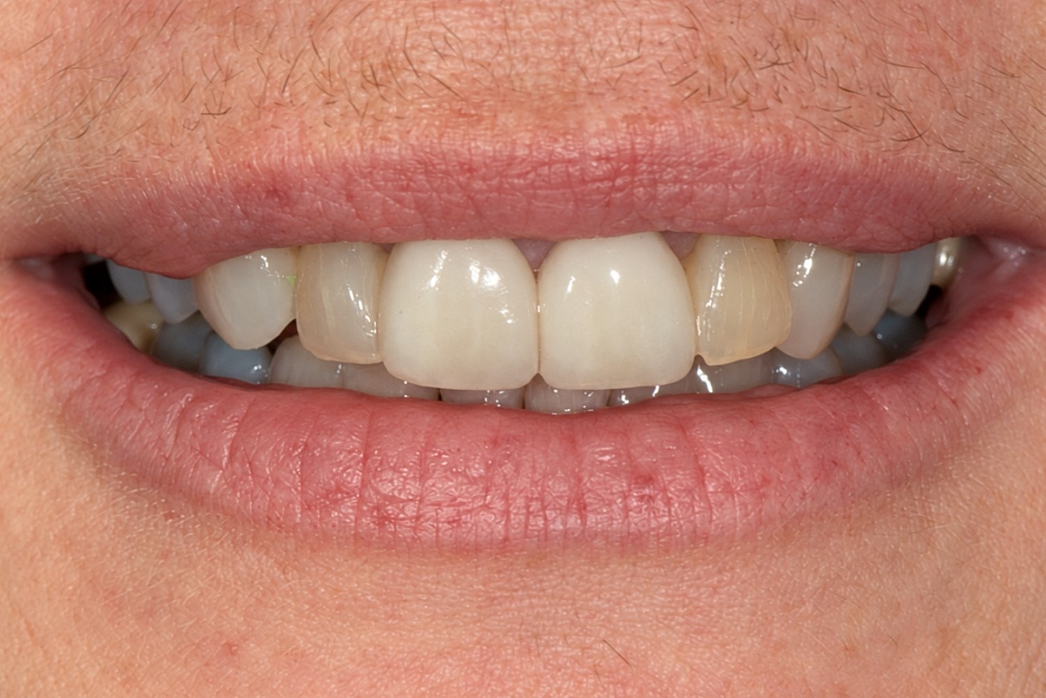 Smile Makeover  Before & After