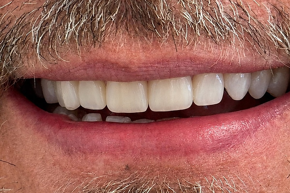 Smile Makeover  Before & After