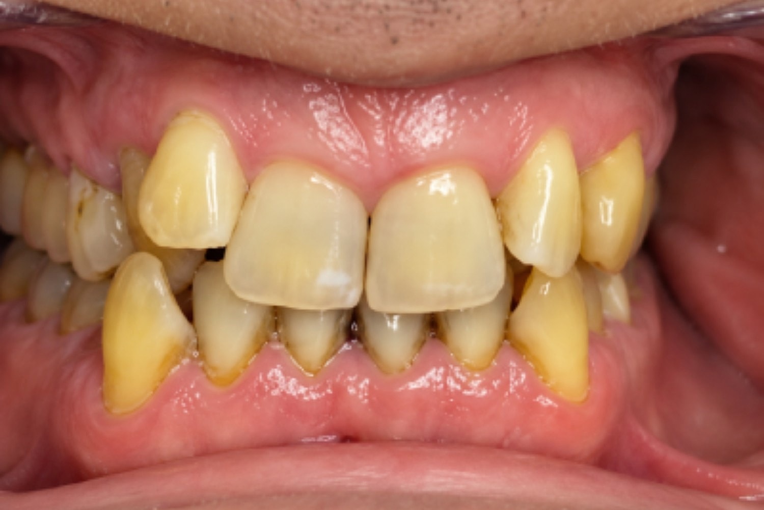 Dental Crowns Before & After